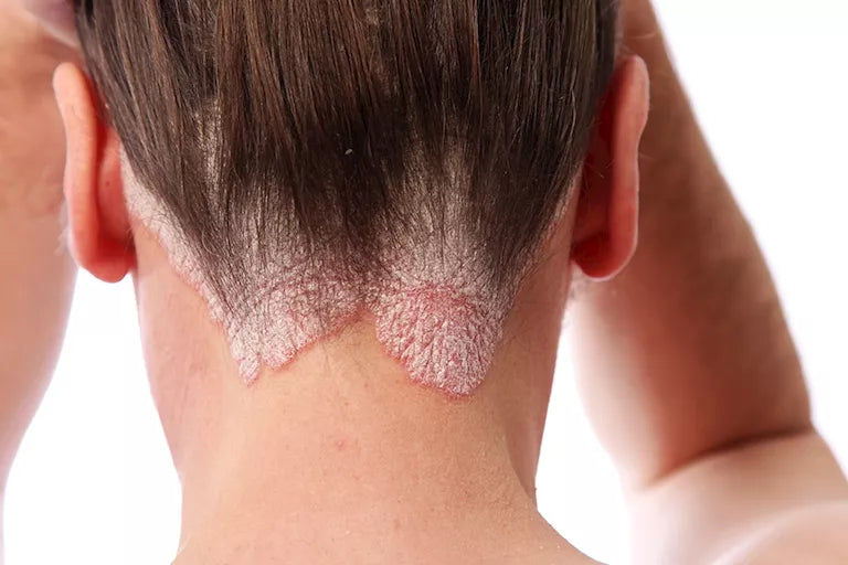 Scalp care ( oily or dry ) itchy , flaky , dandruff, and psoriasis